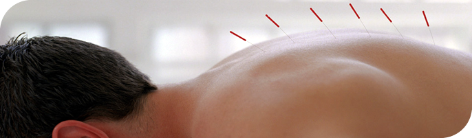 Akupunktur ile bel ve boyun tedavisi