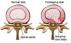 Bel fıtığı (lomber disk hernisi) hakkında