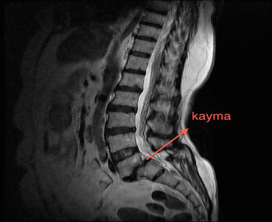 Bel kayması (spondilolistezis) nedir ve nasıl oluşur?