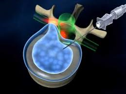 Bel ve boyun fıtığı tedavisinde yeni uygulamalar