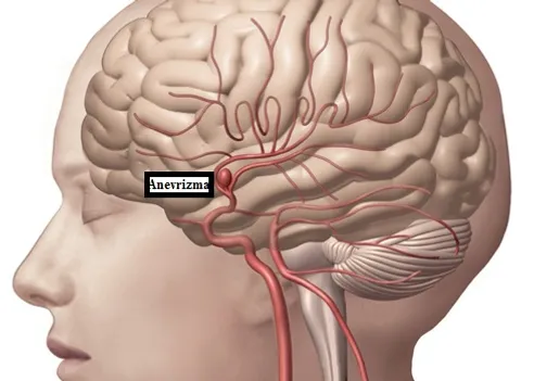 Beyin anevrizmaları ve subaraknoid kanamalar