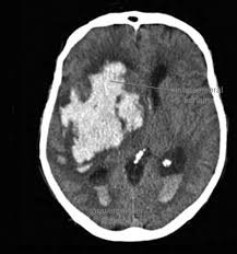 Beyin kanamaları ve tedavisi