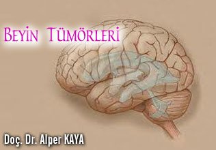 Beyin tümörleri