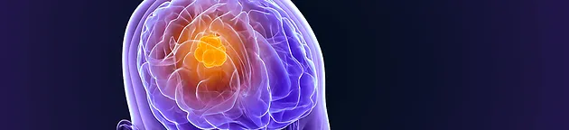 Beyin tümörlerinin belirtileri ve tedavisi