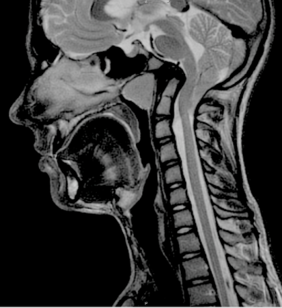 Beyincik sarkması (chiari malformasyonu)
