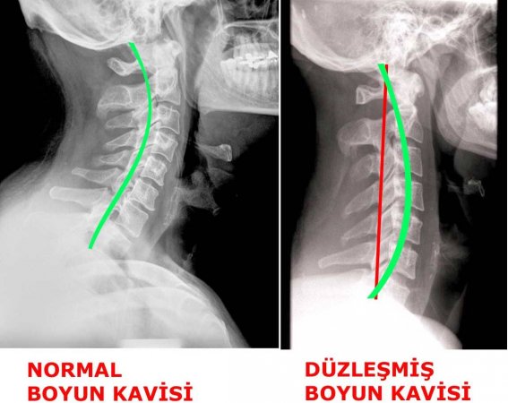 Boyun düzleşmesi hastalığı