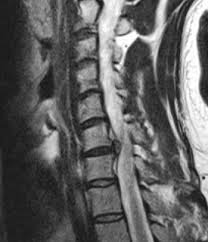 Boyun fıtığı (servikal disk hernisi)
