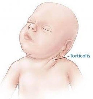 Boyunda eğrilik (tortikolis)