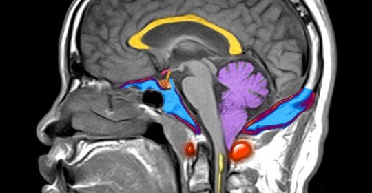 Chiari tip1 malformasyonu