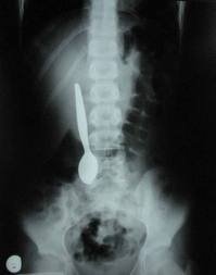 Çocuklarda endoskopi ile yabancı cisim çıkarılması