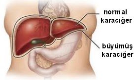 Çocuklarda karaciğer büyümesi