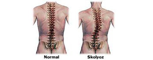 Çocuklarda omurga eğriliği (skolyoz)