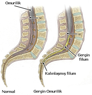 Gergin omurilik sendromu, oluşumu, tanısı ve tedavisi