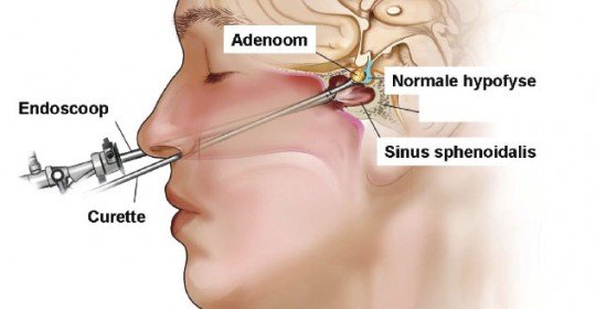 Hipofiz adenomu nedir? Tedavisi nasıl yapılır?