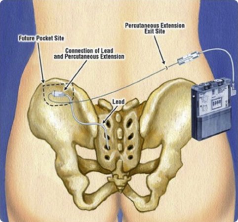 İnterstisyel sistit tedavisinde sakral sinir stimülasyonu