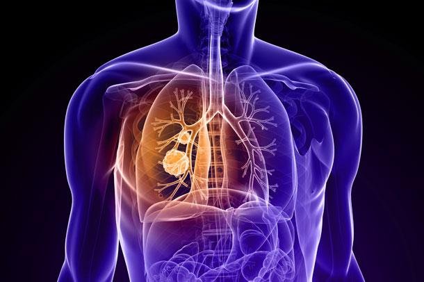 Kanser ağrısı ve tedavisi