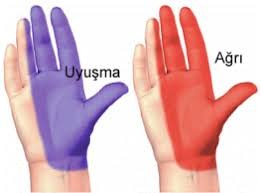 Karpal tünel sendromu (el-bilek kanalında sinir sıkışması hastalığı)