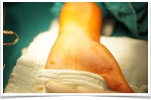 Karpal tunel sendromu nedir? Nasıl tedavi edilir?