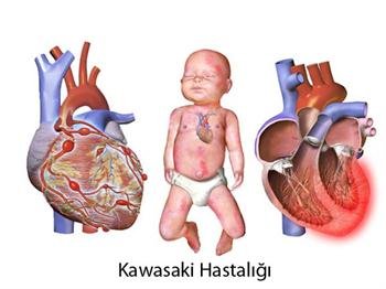 Kawasaki sendromu