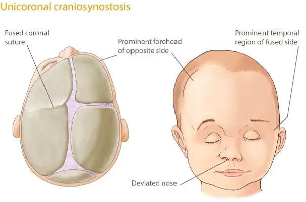 Kraniosinostozis-bebeklerde kafatası kemiklerinde erken kapanma ve şekil bozukluğu