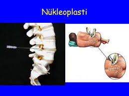 Lazer (nükleoplasti) ile bel fıtığı ameliyatı