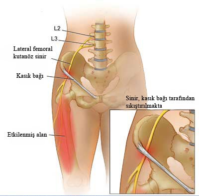 Meraljiya parestetika nedir? Tedavisi nasıl yapılır?