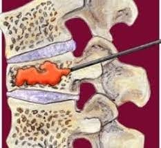Omurga kırıklarının ameliyatsız ve bıçaksız tedavisi