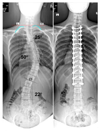 Skolyoz (omurga eğriliği)