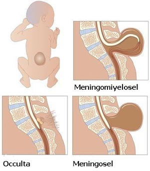 Spina bifida nedir, nasıl oluşur, tedavisi nasıldır?