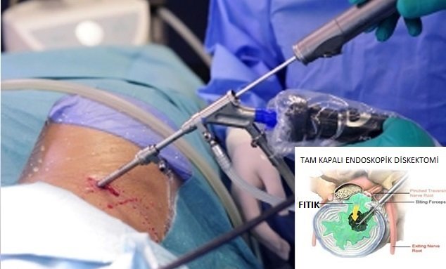 Tam kapalı (endoskopik) bel fıtığı ameliyatı