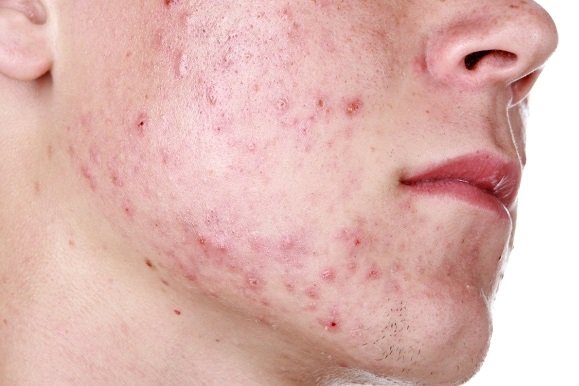 Akne oluşumunda gerçekte ne etkili?