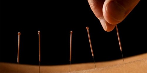 Akupunktur meme kanserinde lenfödemi azaltabilir!