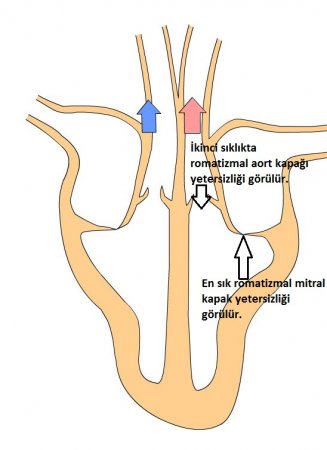 Akut romatizmal ateş nedir?
