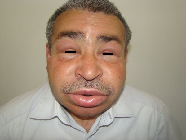 Allerjiyle karışan nadir bir hastalık: herediter anjiyoödem