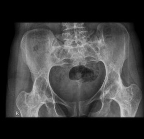 Ankilozan spondilit (as) hastaları için yaşam ipuçları