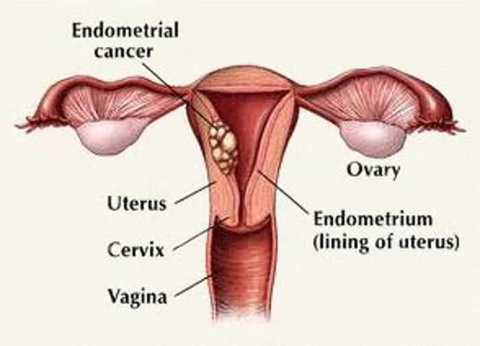 BASİT (ATİPİSİZ) ENDOMETRİAL HİPERPLAZİ TEDAVİSİ  (RAHIM DUVARI KALINLAŞMASI TEDAVİSİ)
