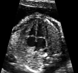 Bir muayene bulgusu olarak üfürüm nedir?