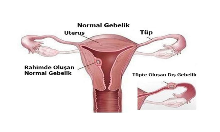 Dış Gebelik (Ektopik Gebelik)