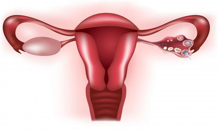 Endometriozis ( Çikolata Kisti )