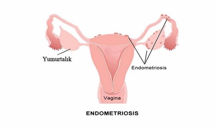Endometriozis Nedir?