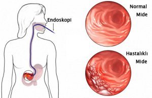 Endoskopik ultrasonografi
