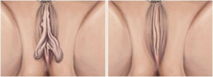 GENİTAL   ESTETİKTE  LABİOPLASTİ