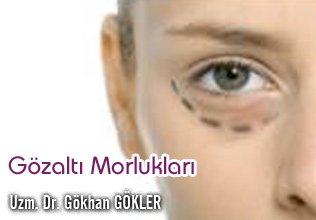 Gözaltı morlukları!