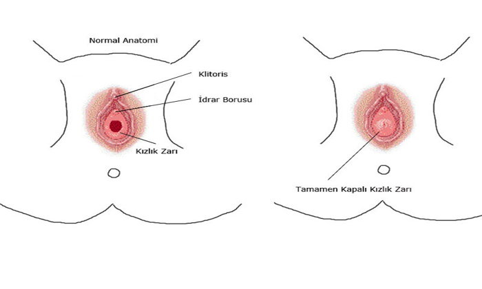 KIZLIK ZARI DİKİMİ