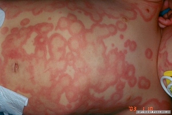 Kurdeşen (ürtiker) / anjiyoödem