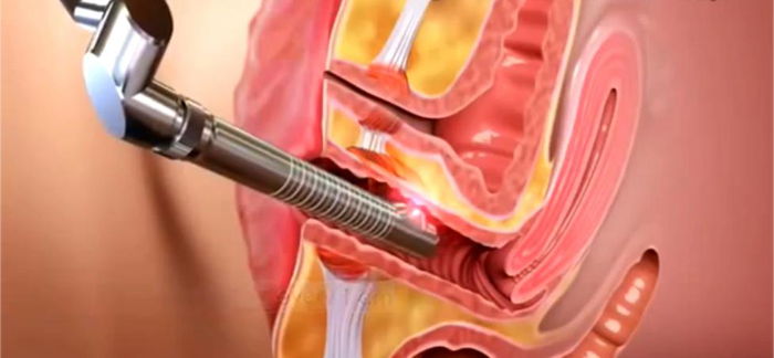 Lazerle Kızlık Zarı Dikimi