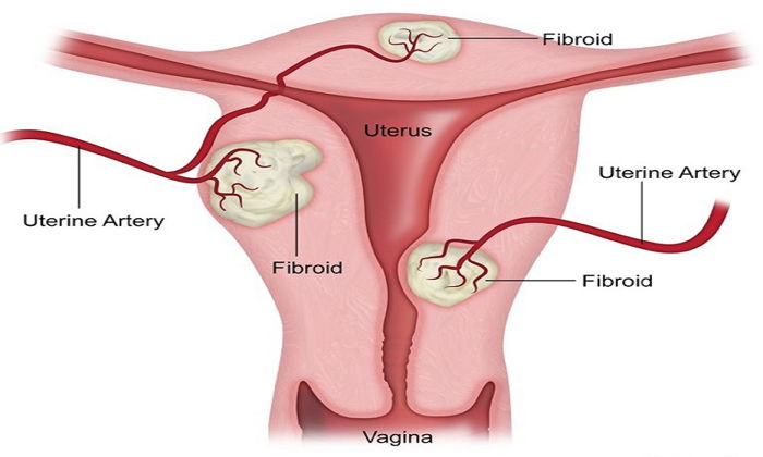 Miyomların Tanı ve Tedavisi