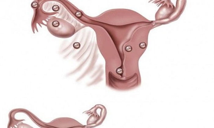 Mol Gebelik; Üzüm Gebeliği