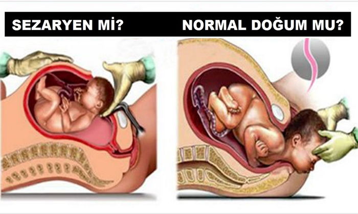 Normal Doğum mu, Sezaryen mi?
