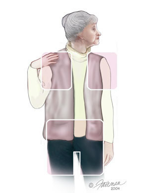 Polimiyaljiya romatika (ağrılı – iltihablı kas romatizması)